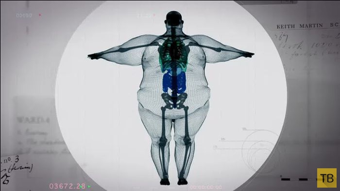 Пугающие рентгеновские снимки тела 400-килограммового мужчины (5 фото)