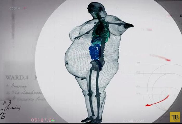 Пугающие рентгеновские снимки тела 400-килограммового мужчины (5 фото)