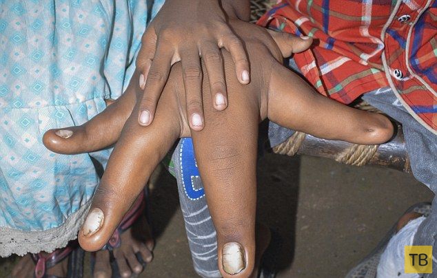 Индийские врачи пытаются помочь мальчику с гигантскими руками (17 фото)