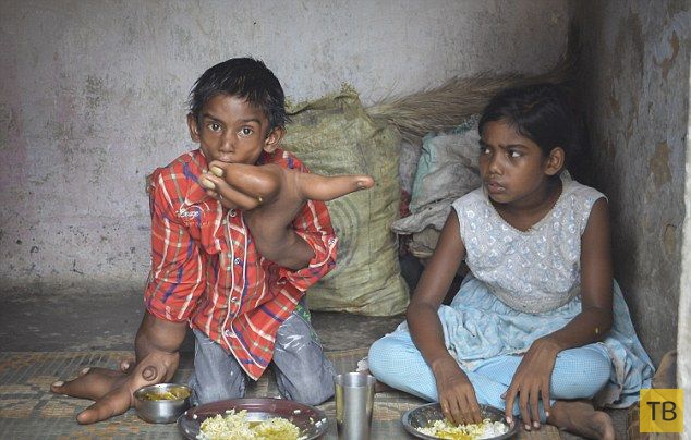 Индийские врачи пытаются помочь мальчику с гигантскими руками (17 фото)