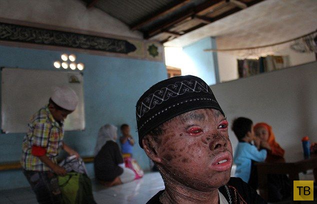 Индонезийский мальчик-змея меняет кожу каждые полтора месяца (7 фото)