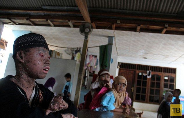 Индонезийский мальчик-змея меняет кожу каждые полтора месяца (7 фото)