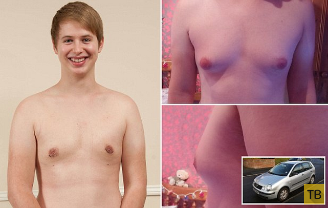 Британский подросток и проблемы с грудью (5 фото)