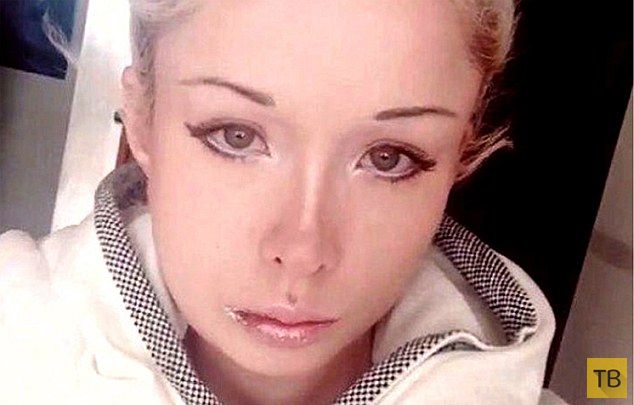 Дерзкие хулиганы напали на Валерию Лукьянову и сделали ей пластику лица (4 фото)