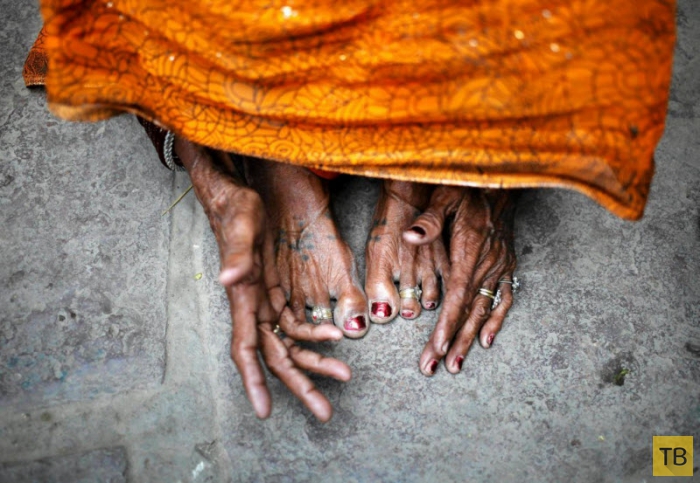 Смертельная стерилизация женщин в Индии (16 фото)